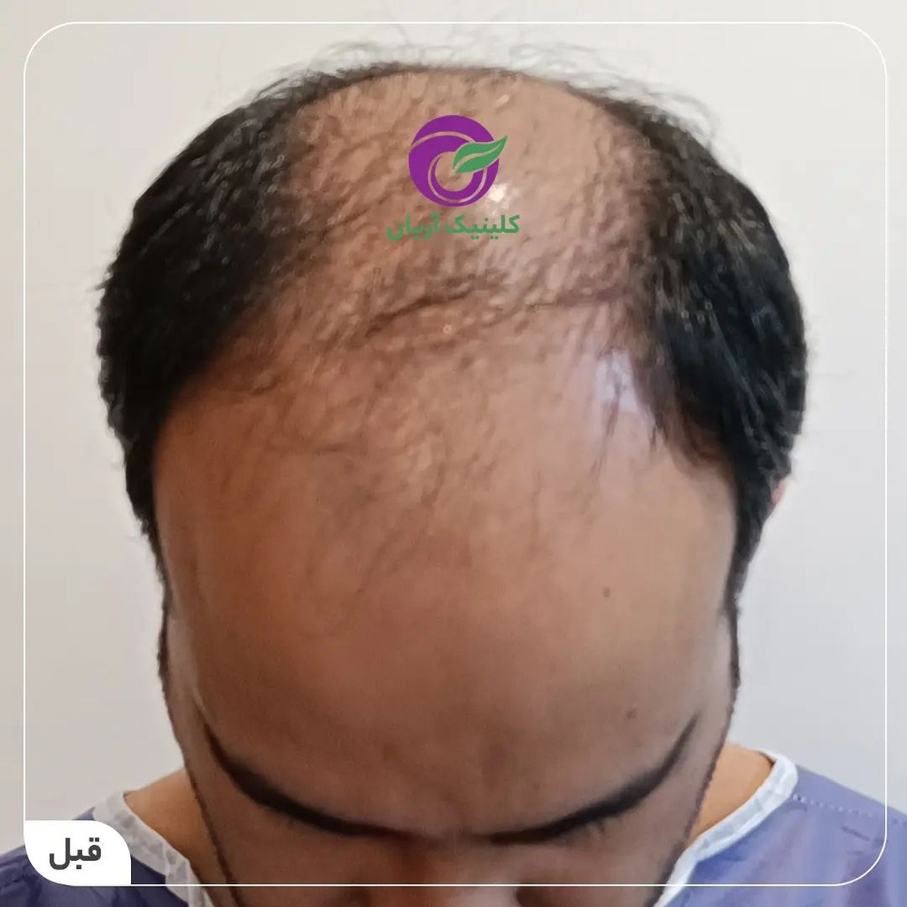کاشت مو در شیراز