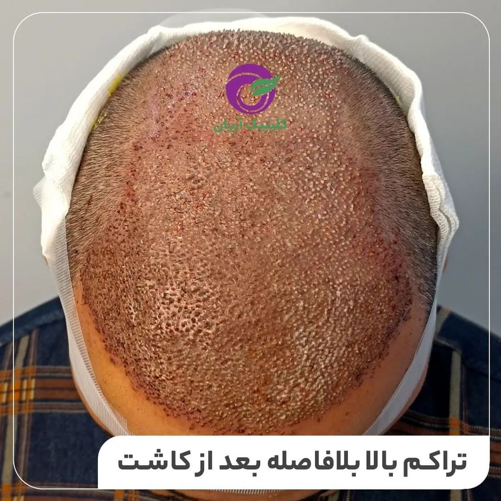 کاشت مو در شیراز