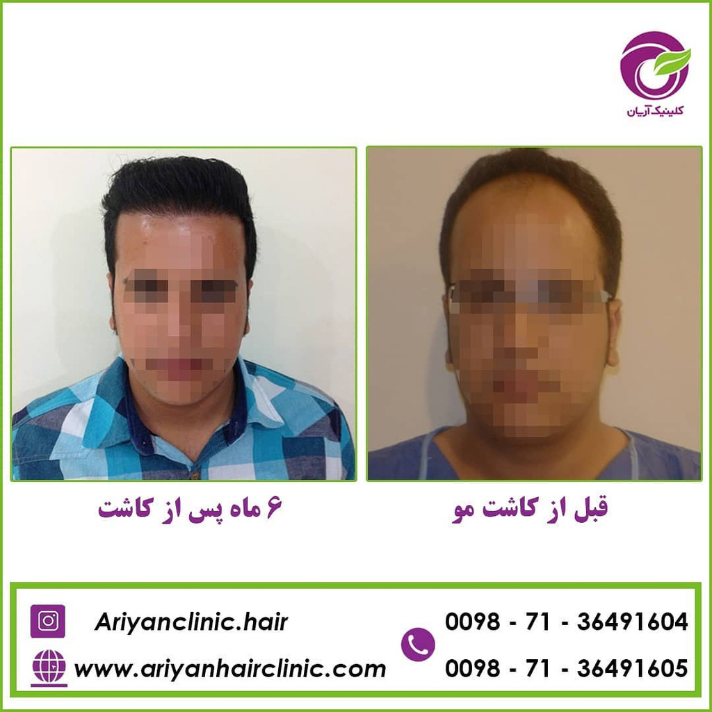 کاشت مو در شیراز