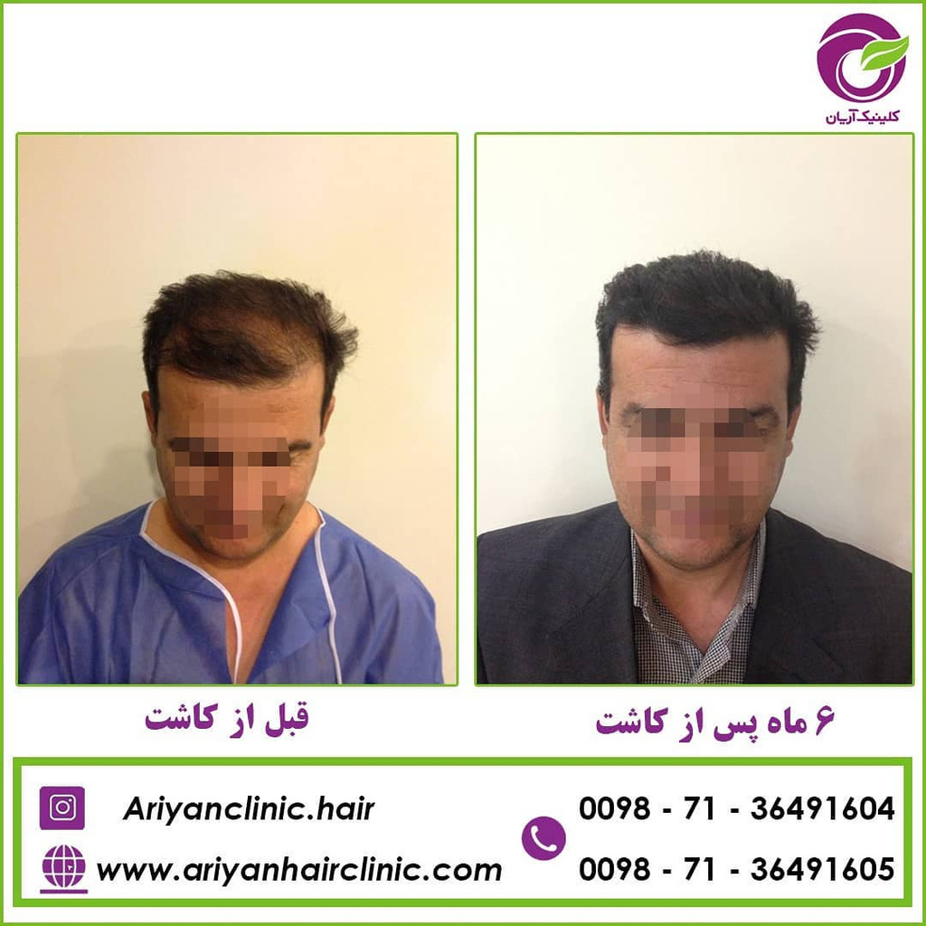 کاشت مو در شیراز