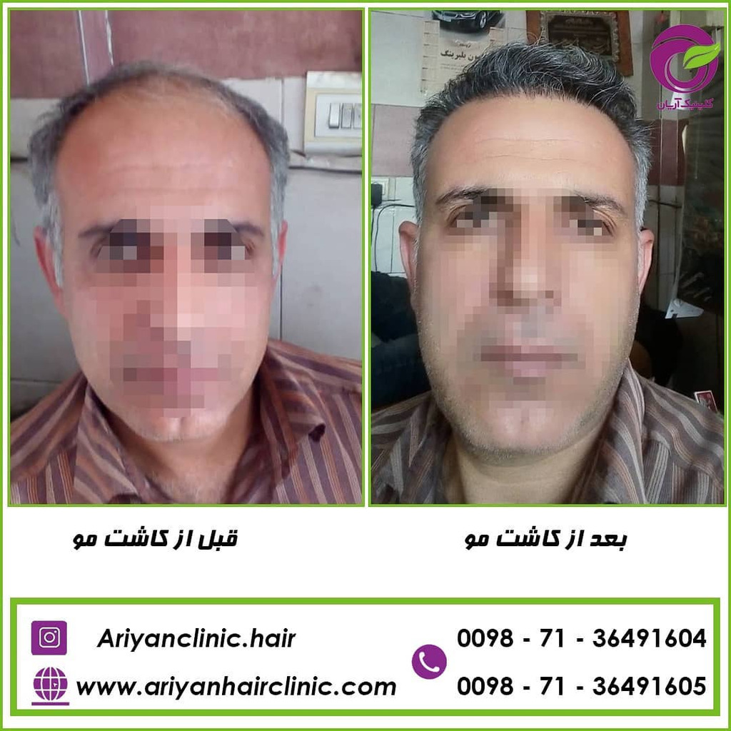 کاشت مو در شیراز