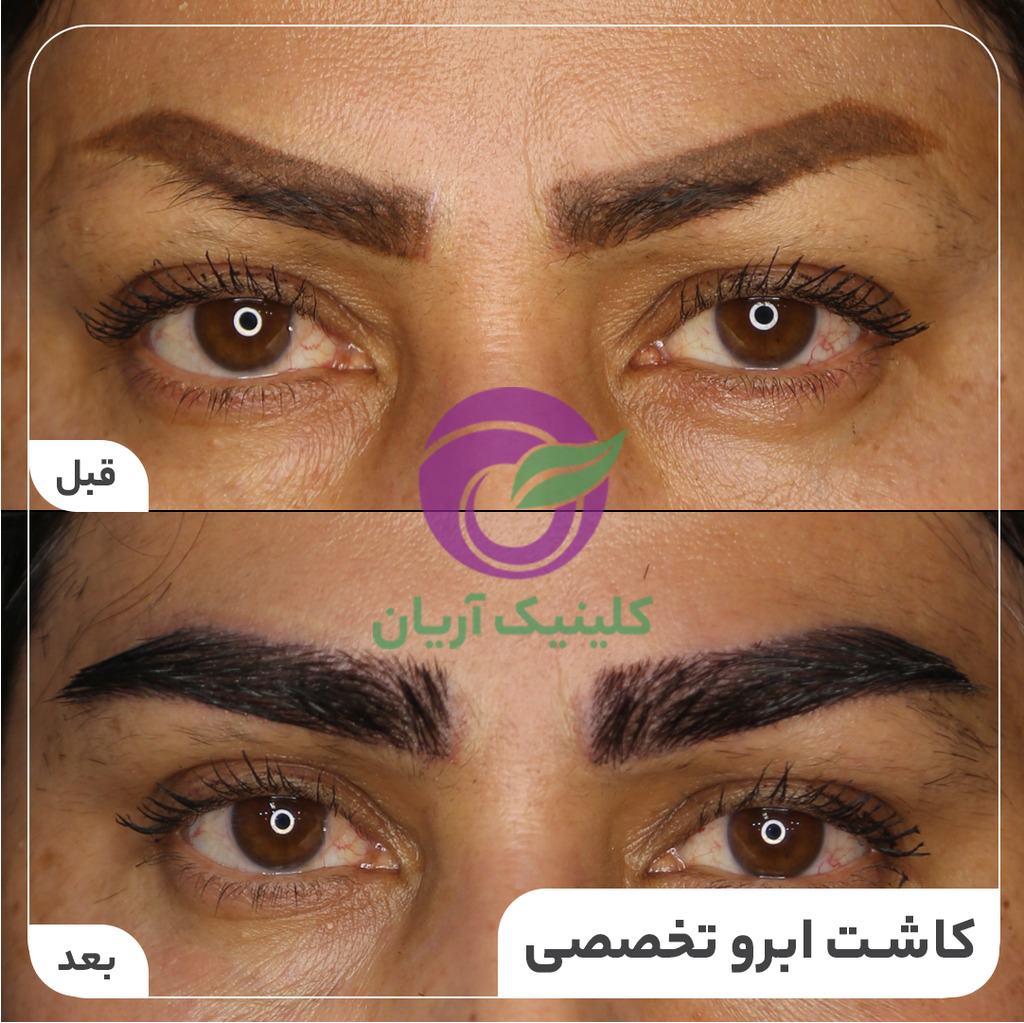 کاشت-ابرو-در-شیراز