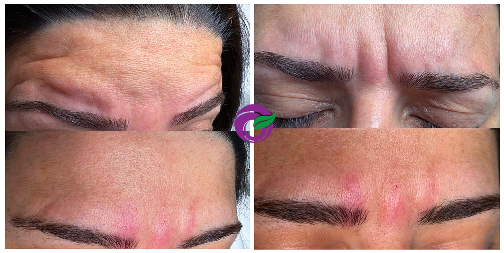 تزریق ژل و بوتاکس در شیراز