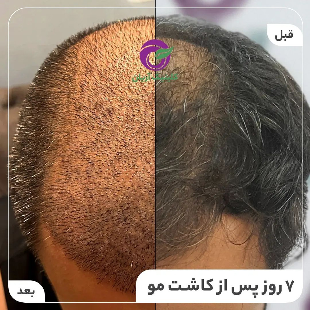 کاشت مو در شیراز