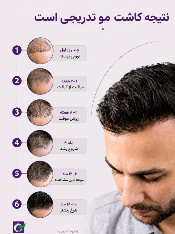 نتیجه کاشت مو چه زمانی دیده می شود؟