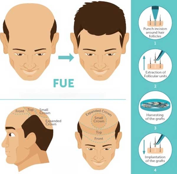 کاشت مو به روش FUE در شیراز