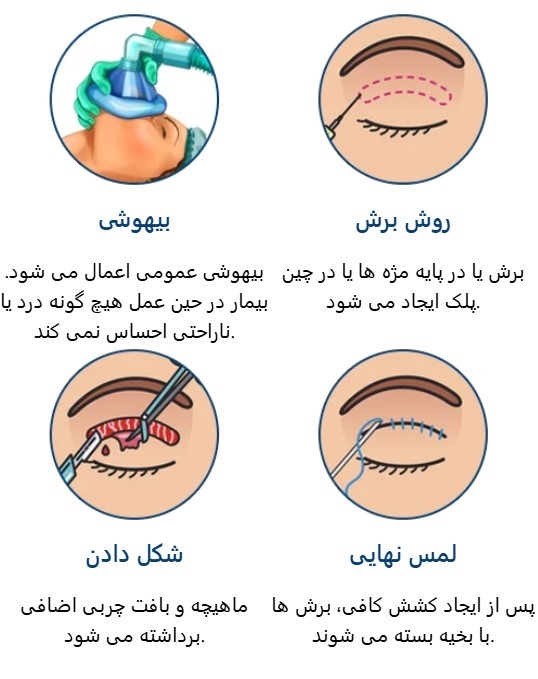 مراحل جراحی بلفاروپلاستی در کلینیک آریان
