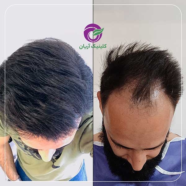 کاشت مو در شیراز کلینیک آریان