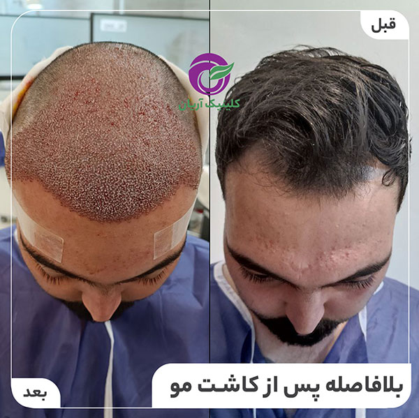 کاشت مو در شیراز کلینیک آریان