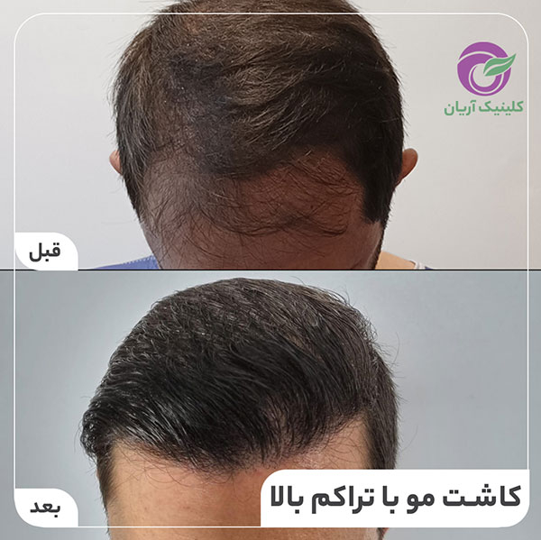 کاشت مو در شیراز کلینیک آریان