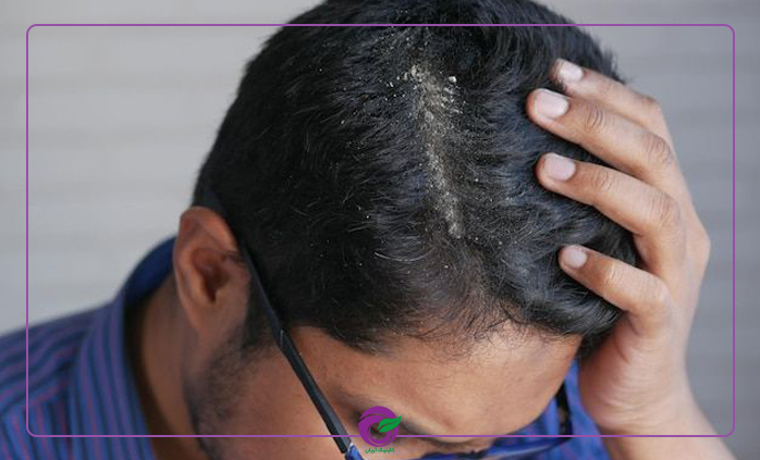 پوسته پوسته شدن سر