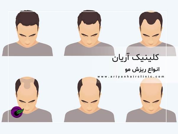 انواع ریزش مو