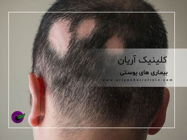 تاثیر بیماری پوستی در ریزش مو