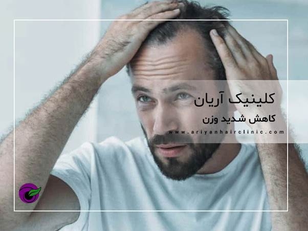 تاثیر وزن در ریزش مو