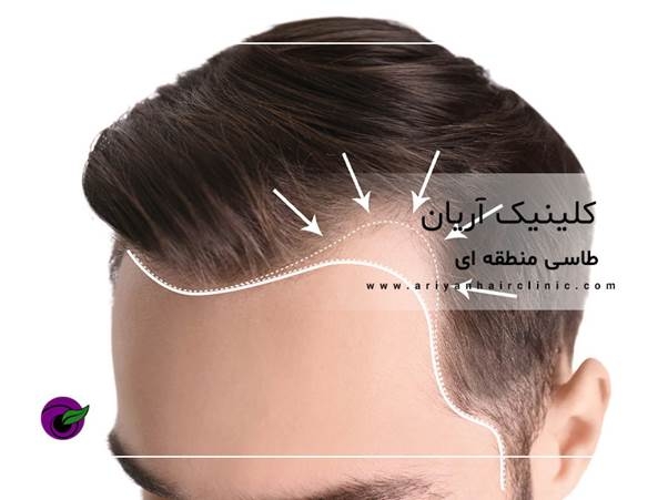 تصویر خط رویش مو در ناحیه شقیقه