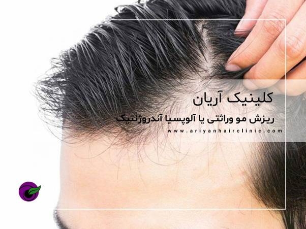 ریزش مو وراثتی یا آلوپسیا آندروژنتیک