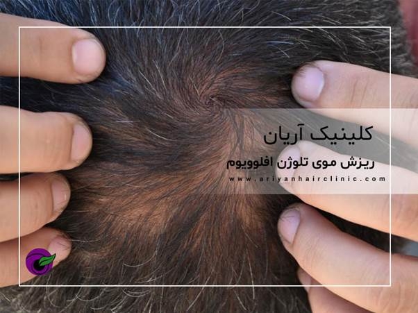 ریزش موی تلوژن افلوویوم