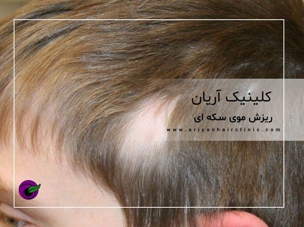 ریزش موی سکه ای