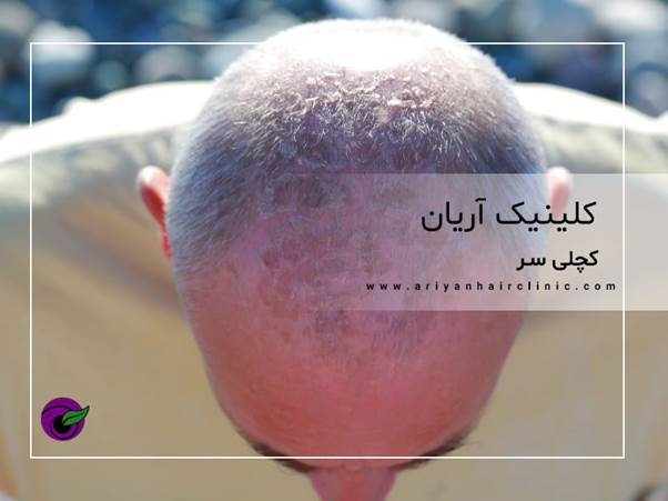 کچلی سر