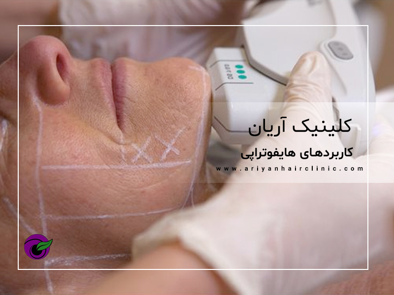 بهترین دکتر هایفوتراپی