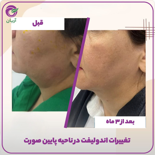 قبل و بعد اندولیفت