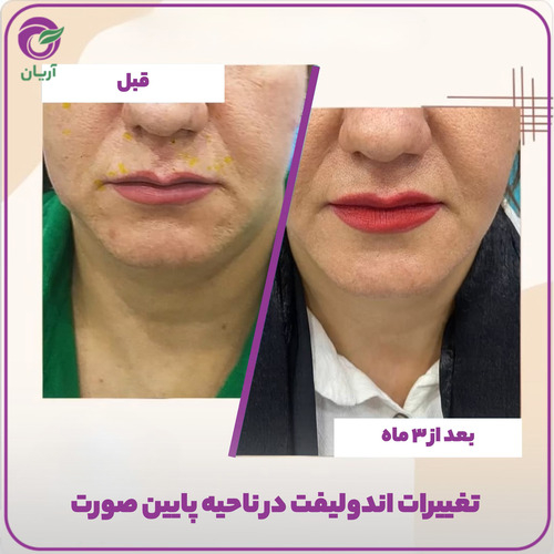 قبل و بعد اندولیفت