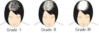Ludwig Scale of Female Pattern Baldness