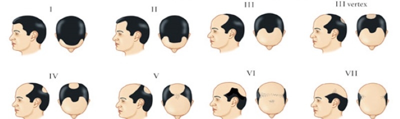 Norwood-Hamilton Male Pattern Baldness Scale