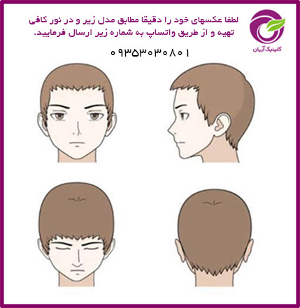 زوایای کاشت مو