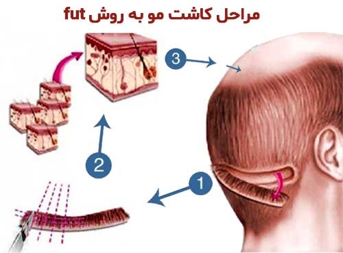 مراحل کاشت مو FUT