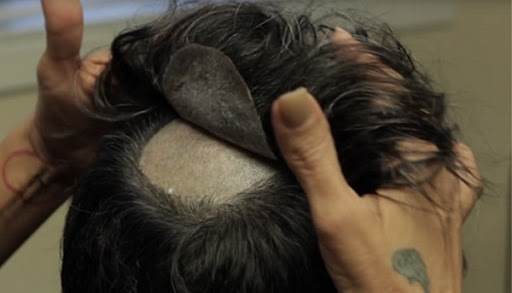 کلینیک کاشت مو آریان