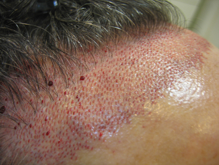 کاشت مو به روش sut