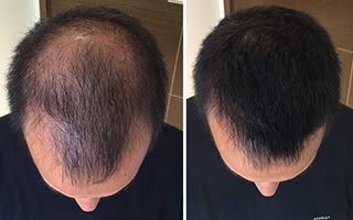 Hair transplantation