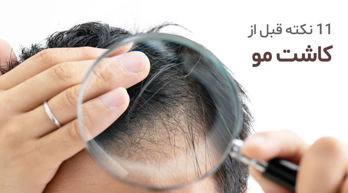 توصیه ها قبل از کاشت مو