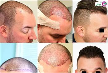 the best country for hair transplant