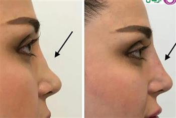 Nose beauty operation without surgery