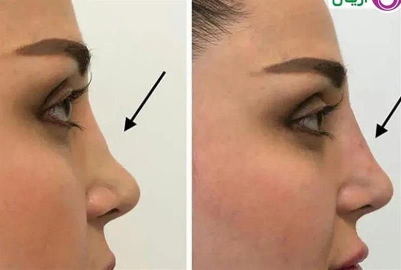 Nose beauty operation without surgery