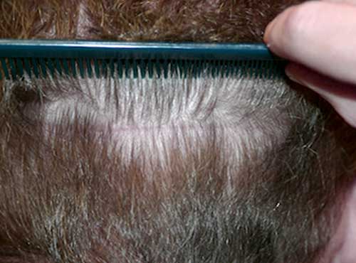 خط اسکار در روش کاشت مو fut