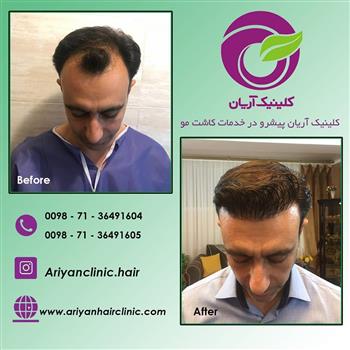 Photos before and after hair transplant