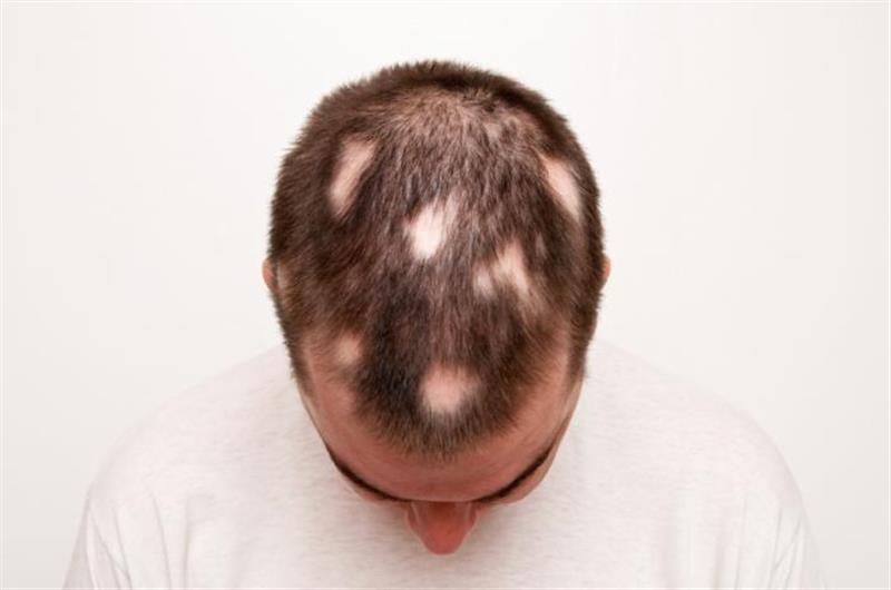 ریزش مو سکه ای یا آلوپسیا چیست؟