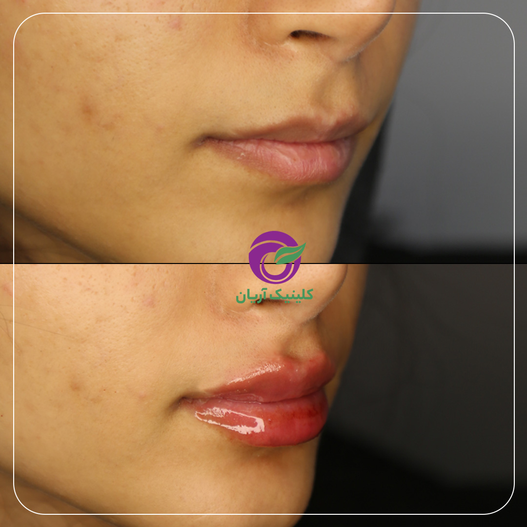 تصاویر قبل و بعد از تزریق ژل