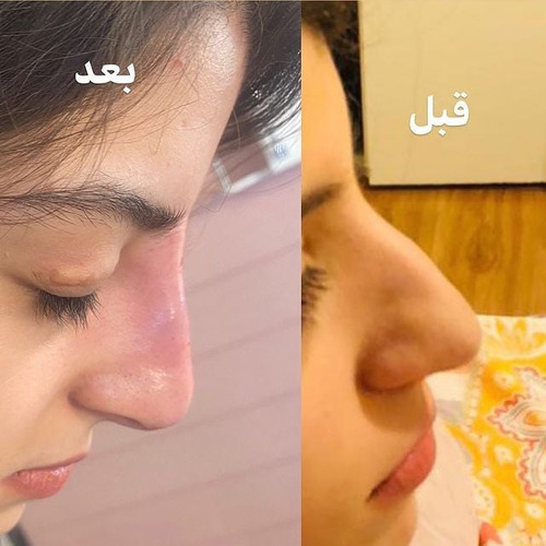تصاویر قبل و بعد از تزریق ژل