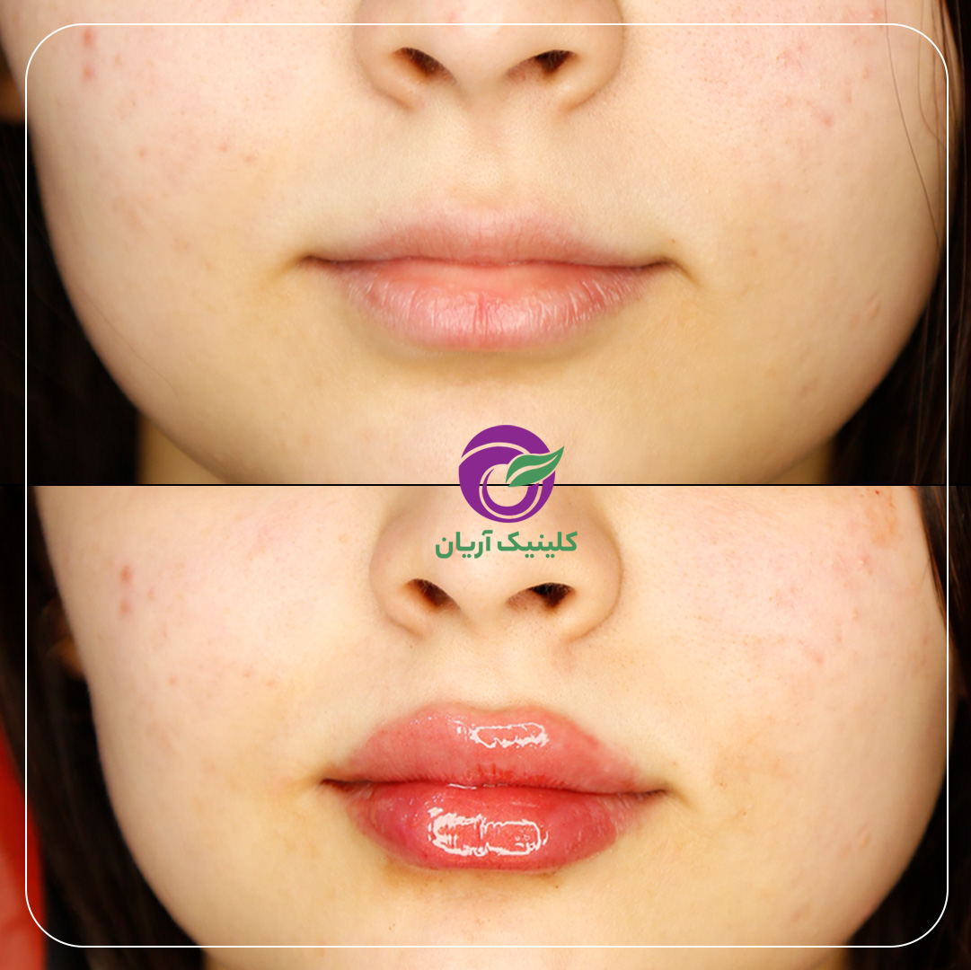 تصاویر قبل و بعد از تزریق ژل