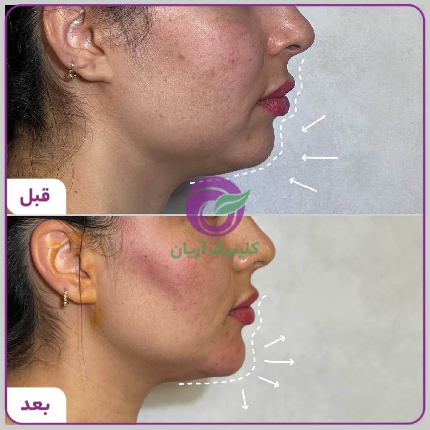 تصاویر قبل و بعد از تزریق ژل