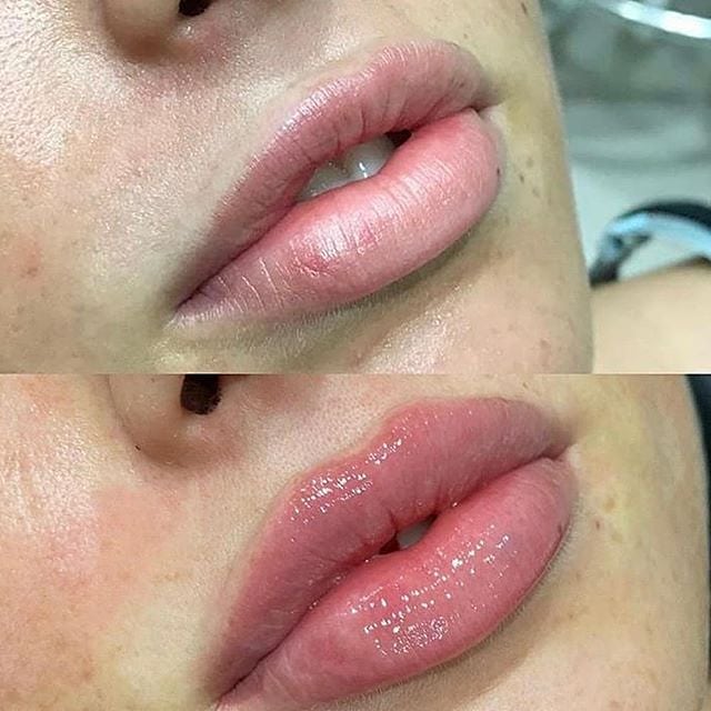 تصاویر قبل و بعد از تزریق ژل