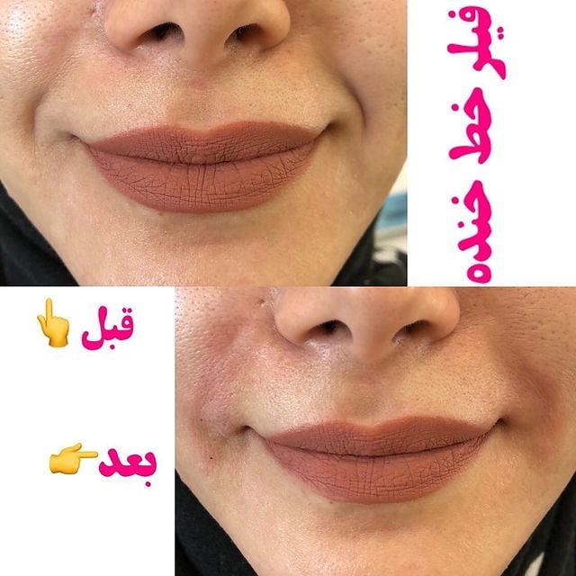 تصاویر قبل و بعد از تزریق ژل