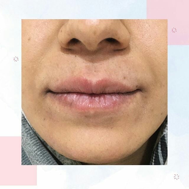 تصاویر قبل و بعد از تزریق ژل