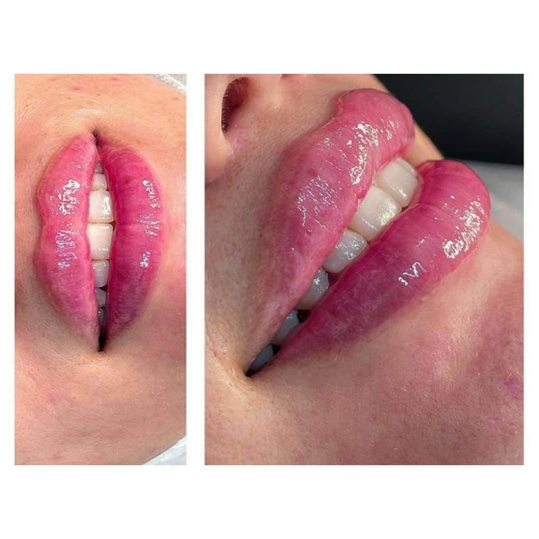 تصاویر قبل و بعد از تزریق ژل