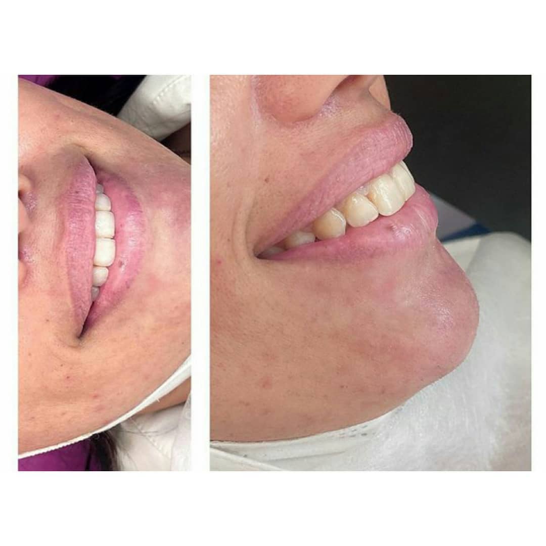 تصاویر قبل و بعد از تزریق ژل