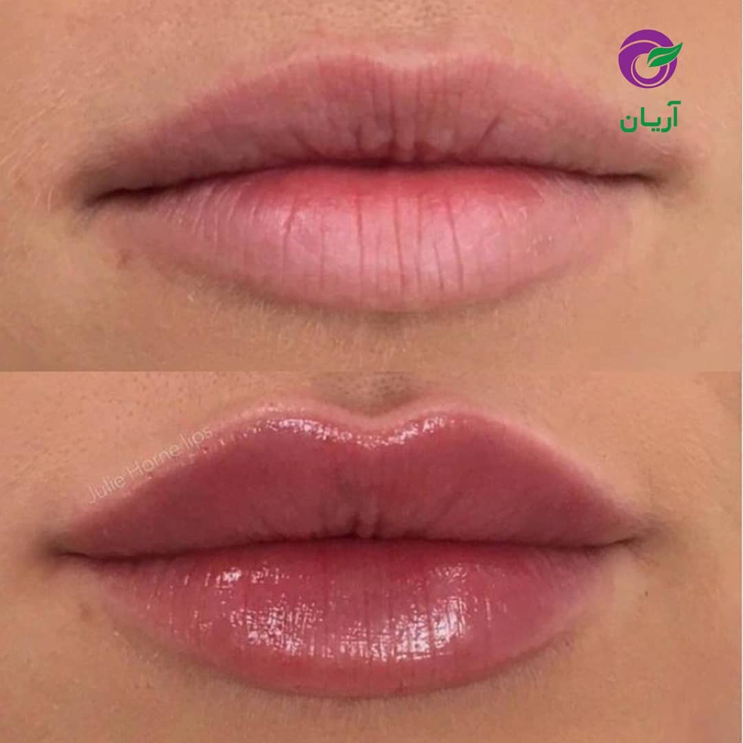 تصاویر قبل و بعد از تزریق ژل